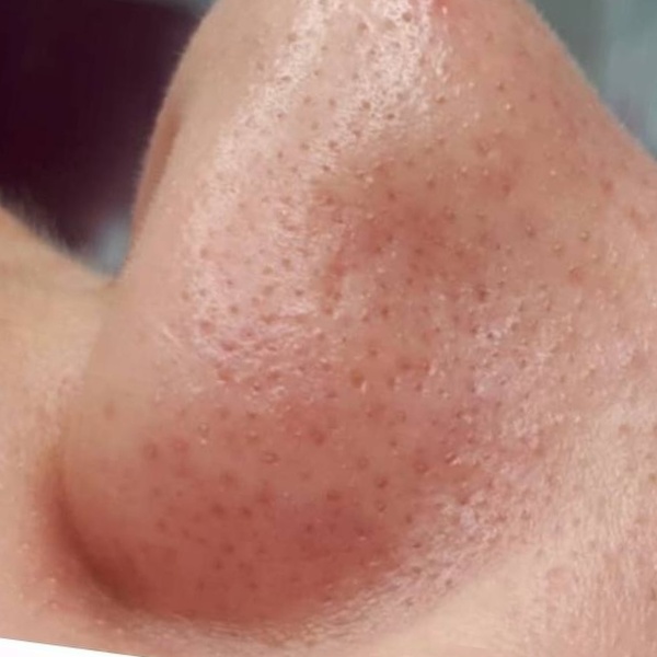 CosMarSpa client treatment comparison 1 — first image