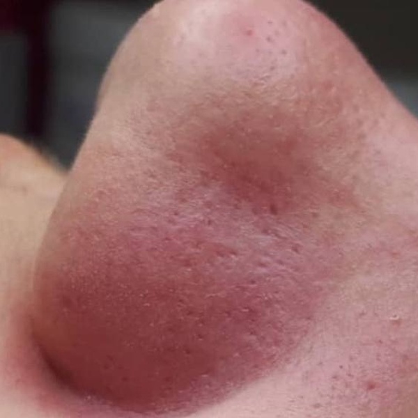 CosMarSpa client treatment comparison 1 — second image
