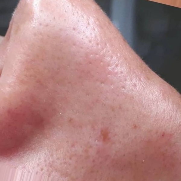 After treatment — CosMarSpa client comparison 2