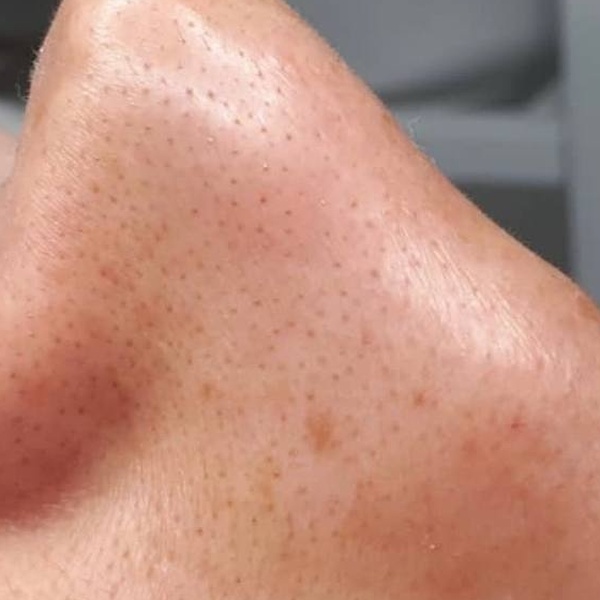 Before treatment — CosMarSpa client comparison 2