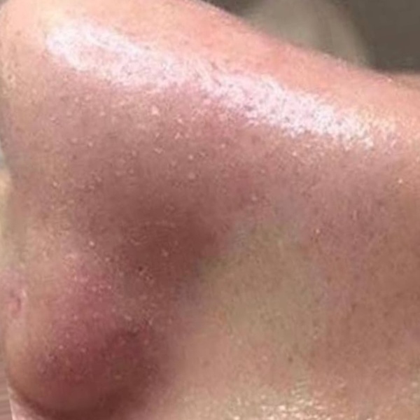 After treatment — CosMarSpa client comparison 3