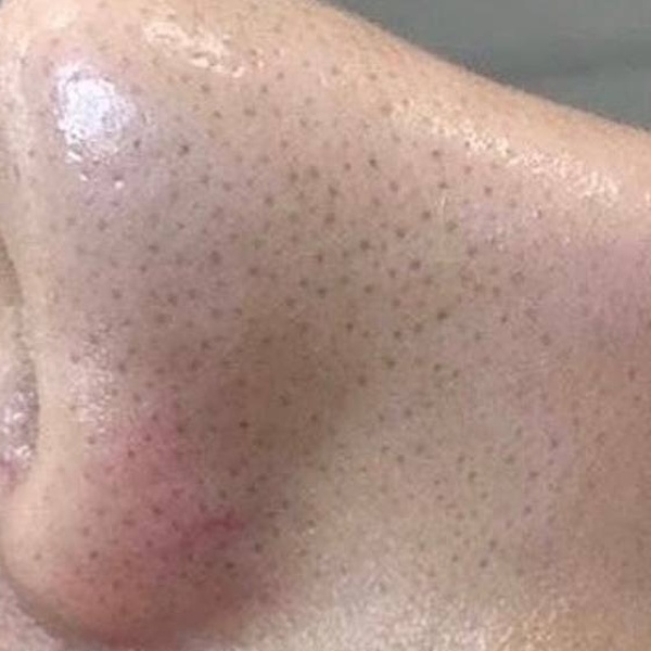 Before treatment — CosMarSpa client comparison 3