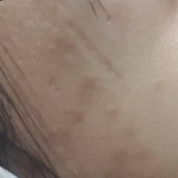 After treatment — CosMarSpa client comparison 4