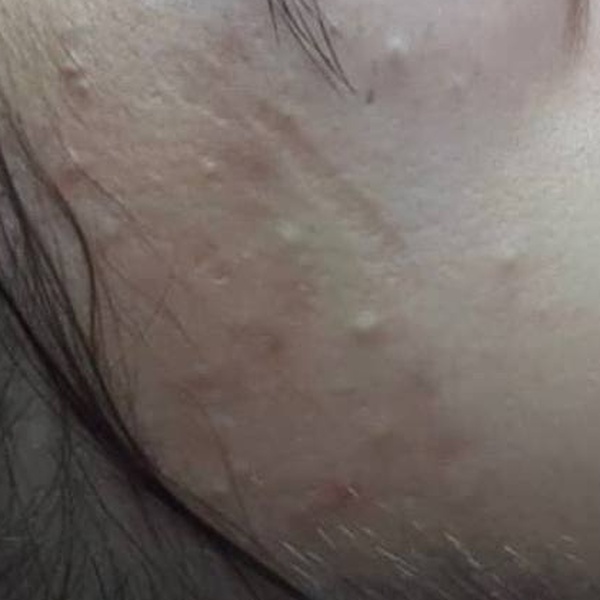 Before treatment — CosMarSpa client comparison 4