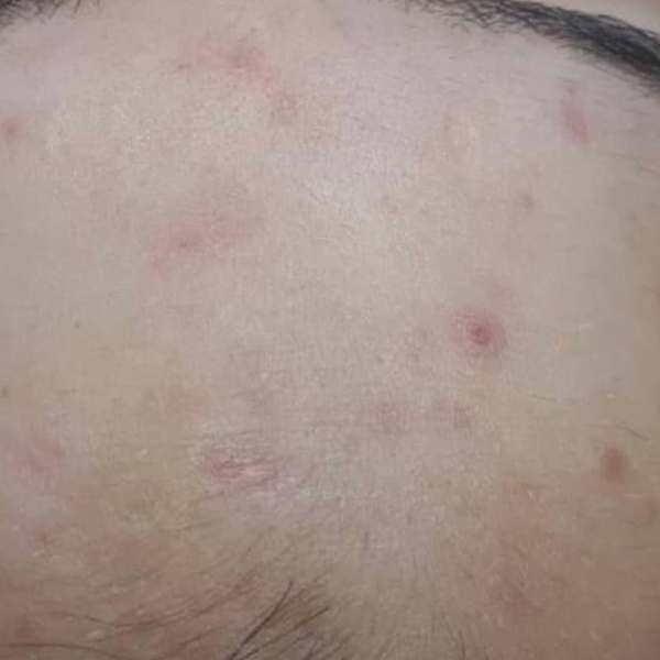 After treatment — CosMarSpa client comparison 5