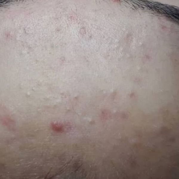 Before treatment — CosMarSpa client comparison 5