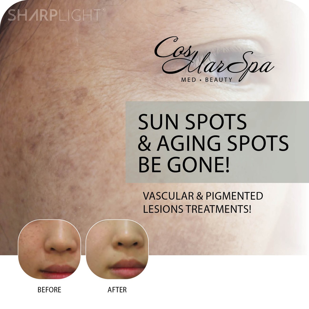 Sun and aging spots treatment
