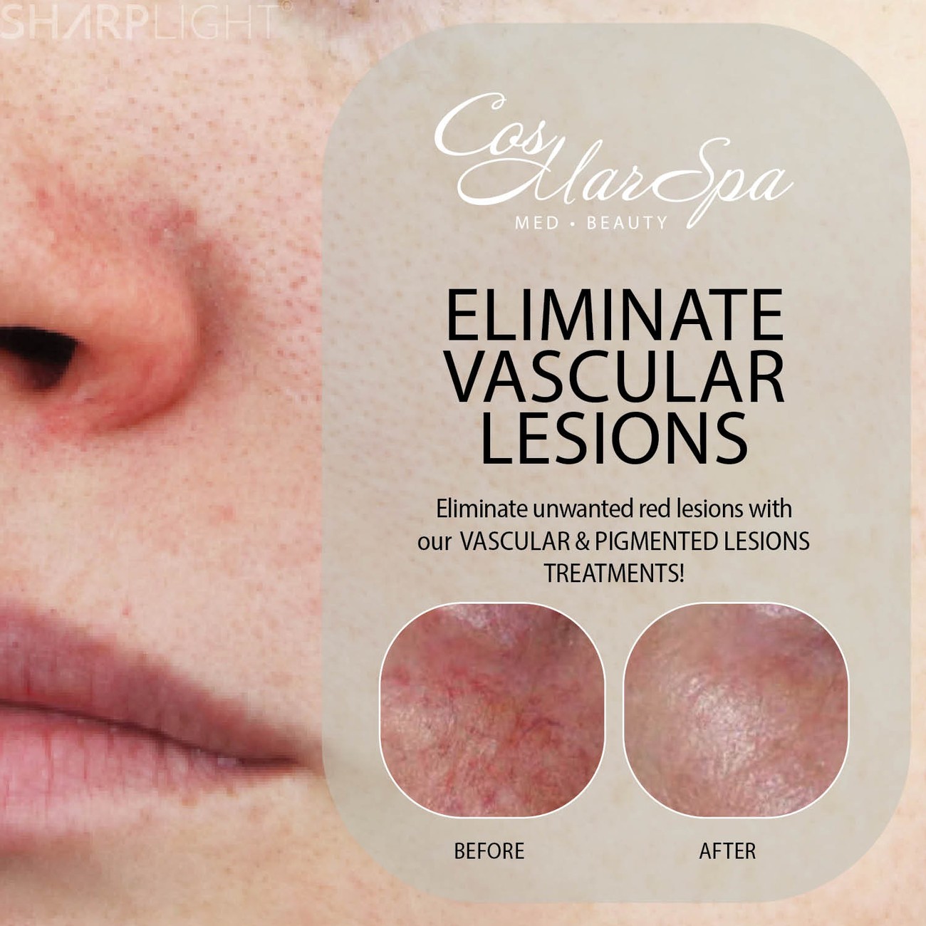 Vascular lesion treatment